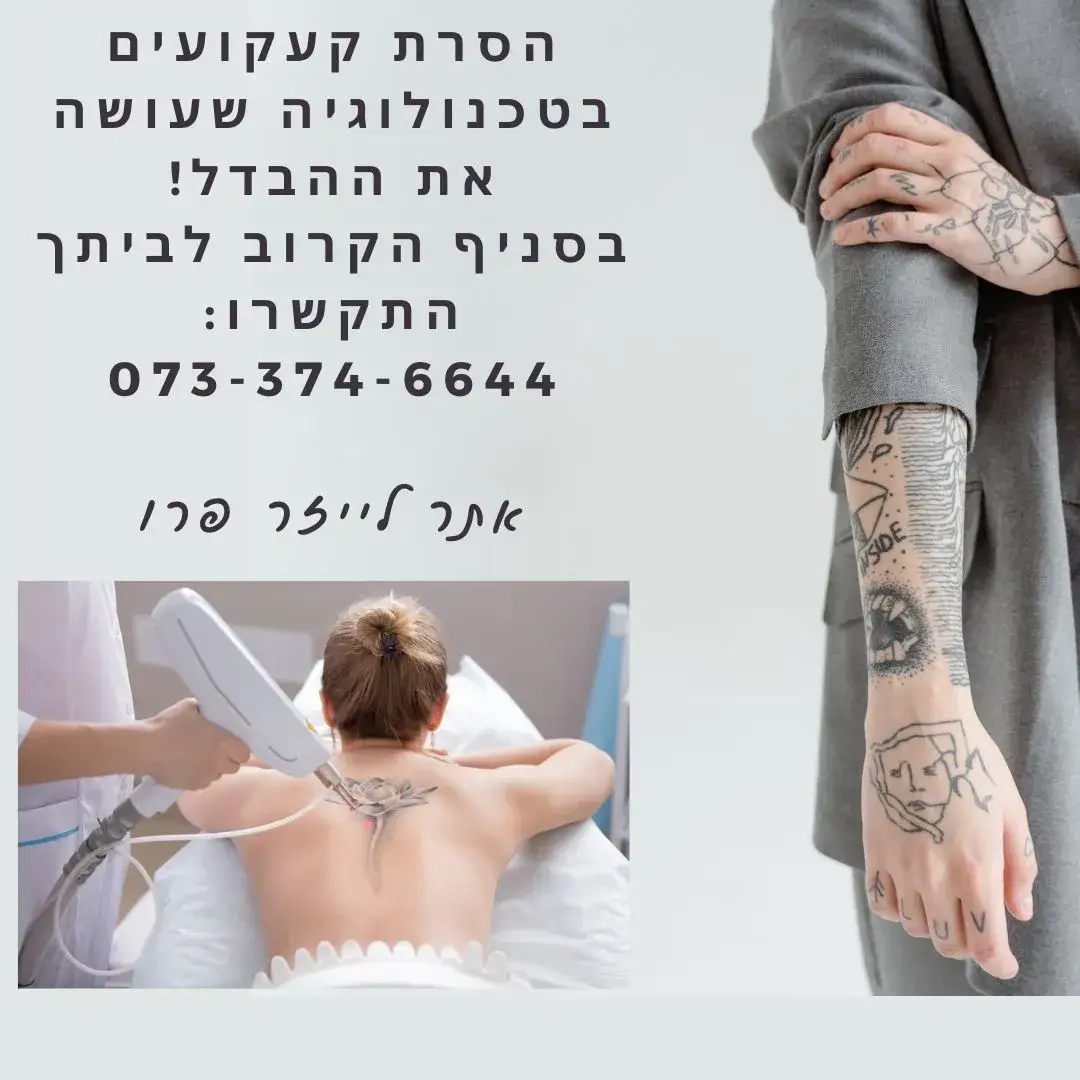 הסרת קעקועים בעפולה