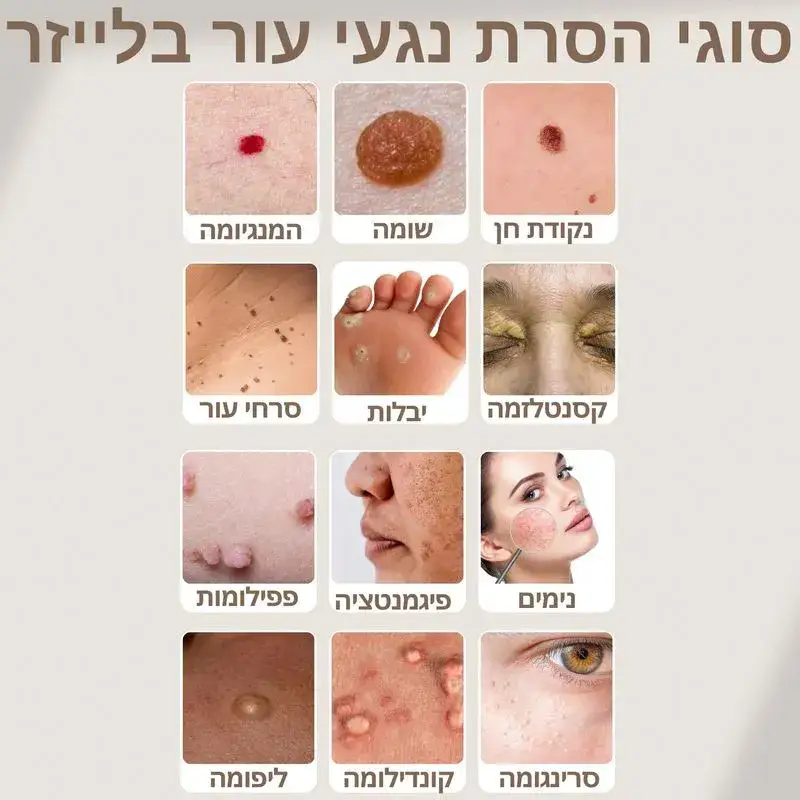 סוגי הסרת נגעי עור בלייזר