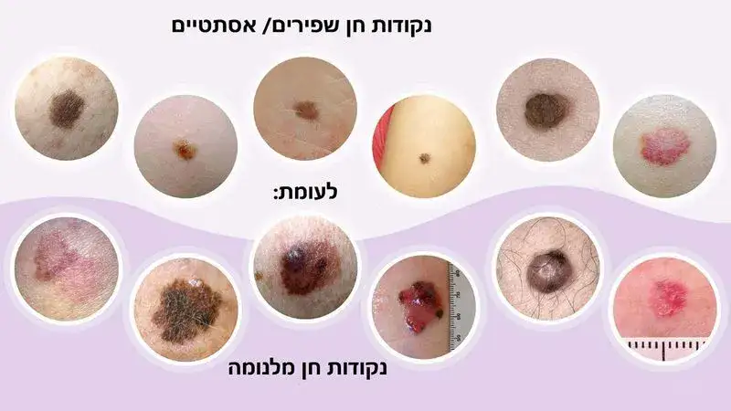 בחירת שיטת הטיפול להסרת נקודות חן - שפירות ומלנומה