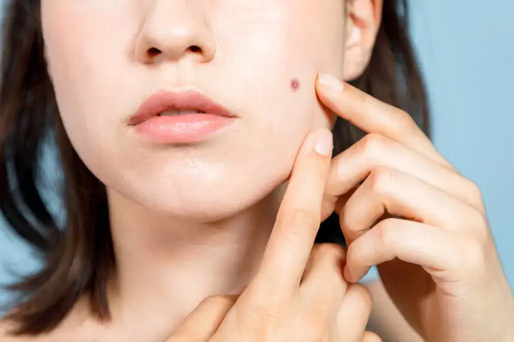 הסרת נקודות חן בפנים