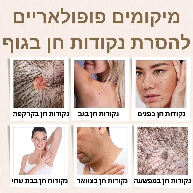 מיקומים פופולאריים להסרת נקודות חן בגוף