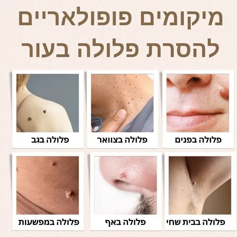 מיקומים פופולאריים לפלולות בגוף