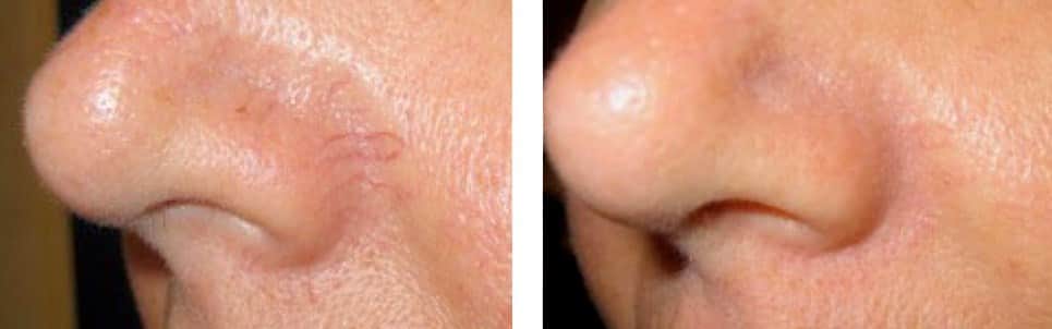 העלמת נימים באף | הסרת נימים באף