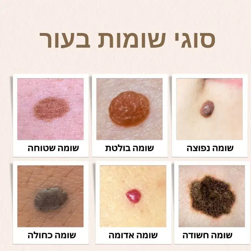 סוגי שומות בעור