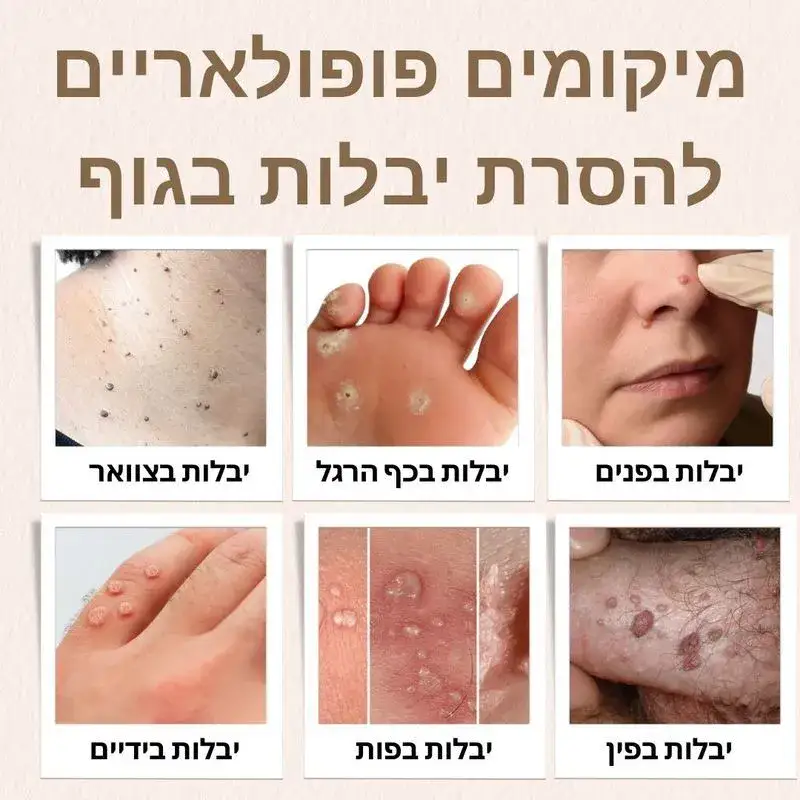 הסרת יבלות - מיקומים פופולאריים