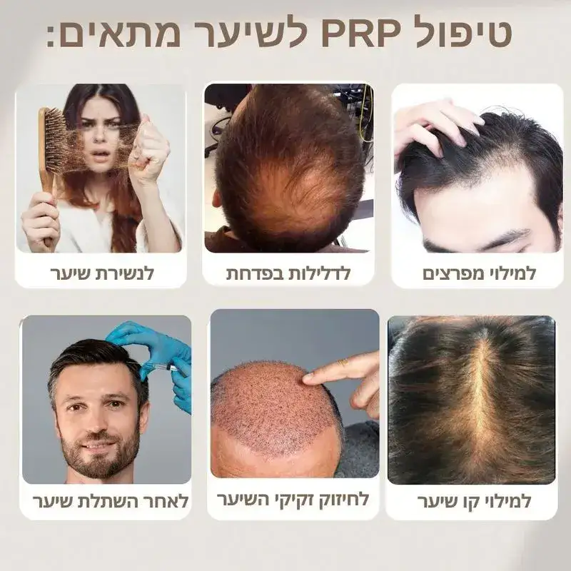 טיפול PRP לשיער -  מתאים במקרים הללו
