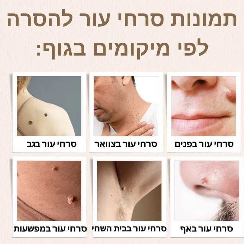 הסרת שומות בלייזר