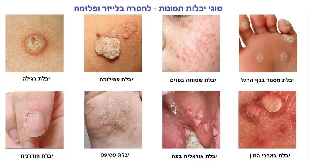 סוגי יבלות תמונות