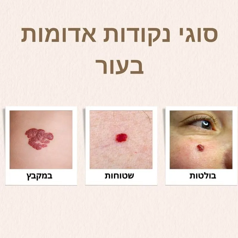 סוגי נקודות אדומות