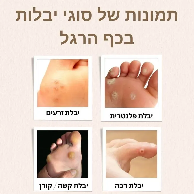 יבלות בכף הרגל