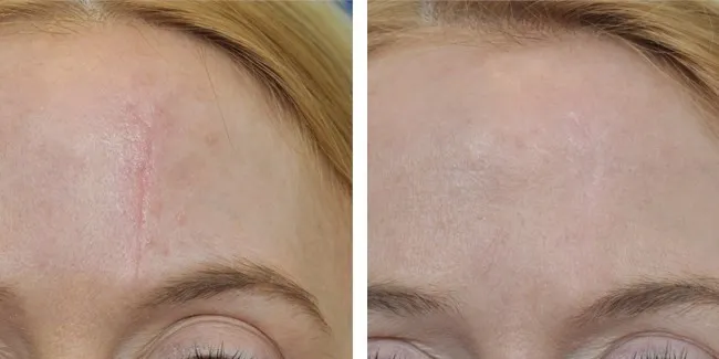 הסרת צלקות בראשון לציון