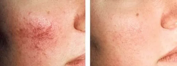 העלמת נימים בראשון לציון