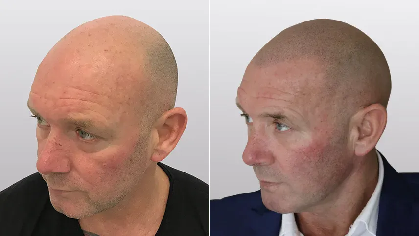 הדמיית שיער בגן יבנה לפני ואחרי