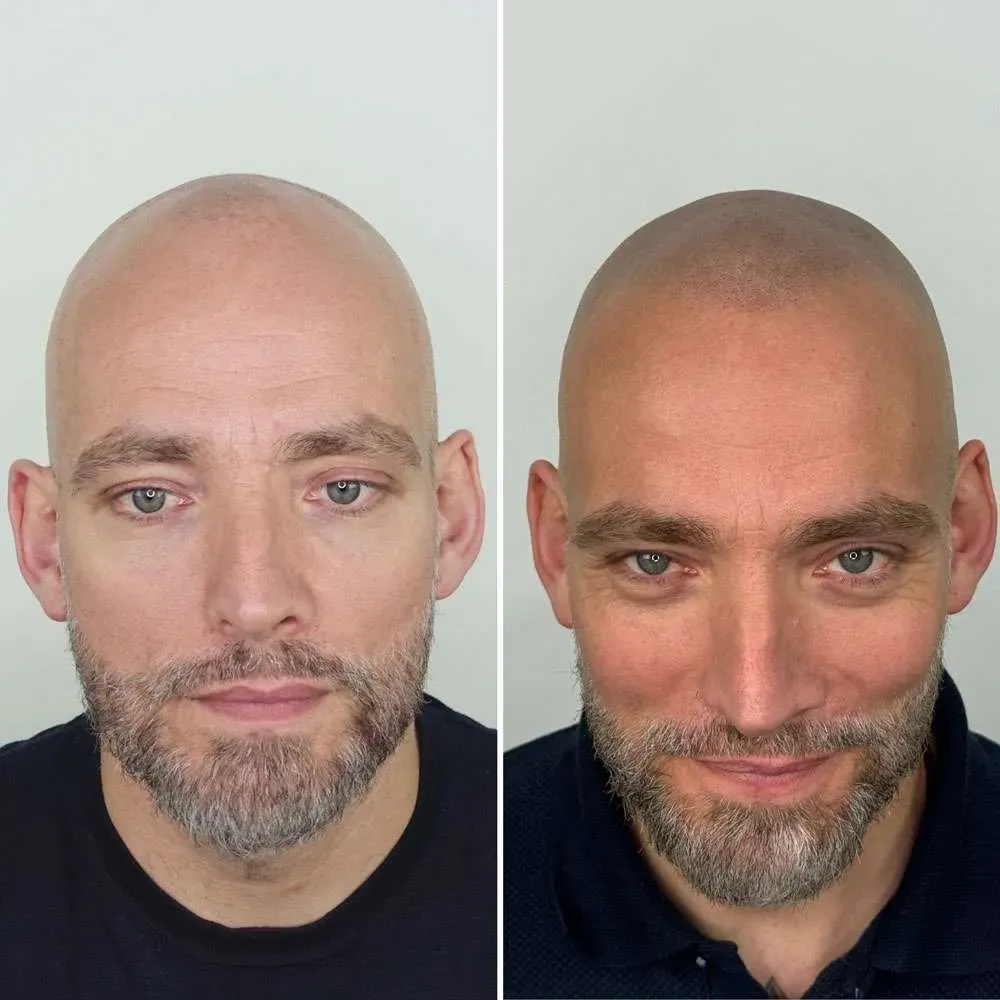 הדמיית שיער בגן יבנה לפני ואחרי