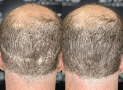 העלמת צלקות בהדמיית שיער לפני ואחרי 