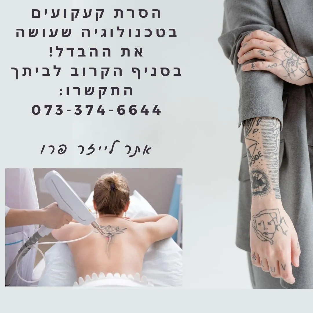 הסרת קעקועים באשדוד