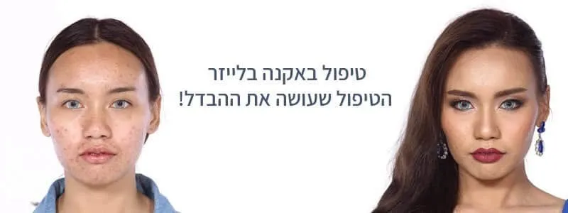 טיפול באקנה באשדוד בלייזר