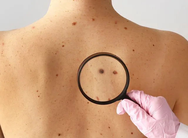 אבחון נגעי עור