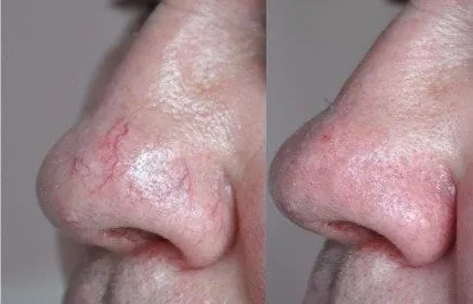 הסרת נימים באף - לפני ואחרי