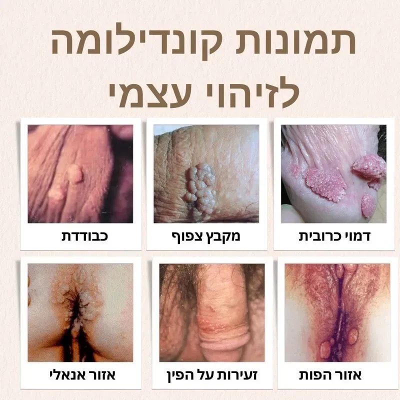 תמונות קונדילומה לזיהו עצמי