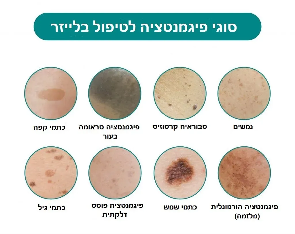 סוגי פיגמנטציה