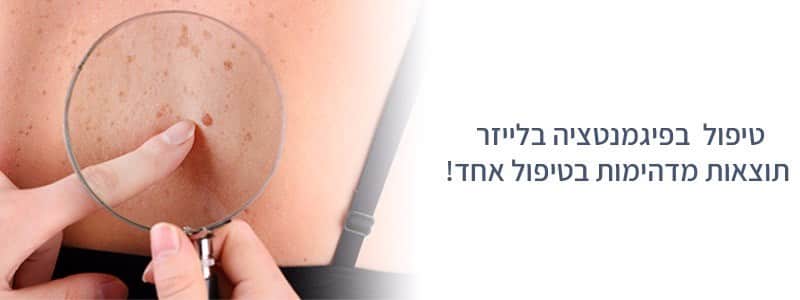 טיפול בפיגמנטציה בלייזר באשדוד