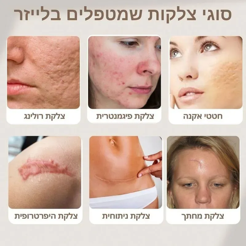 סוגי צלקות שמטפלים בלייזר