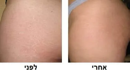 העלמת סימני מתיחה בירכיים  באשקלון - לפני ואחרי