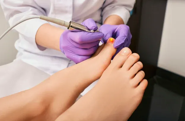 טיפול בפטרת ציפורניים בלייזר 