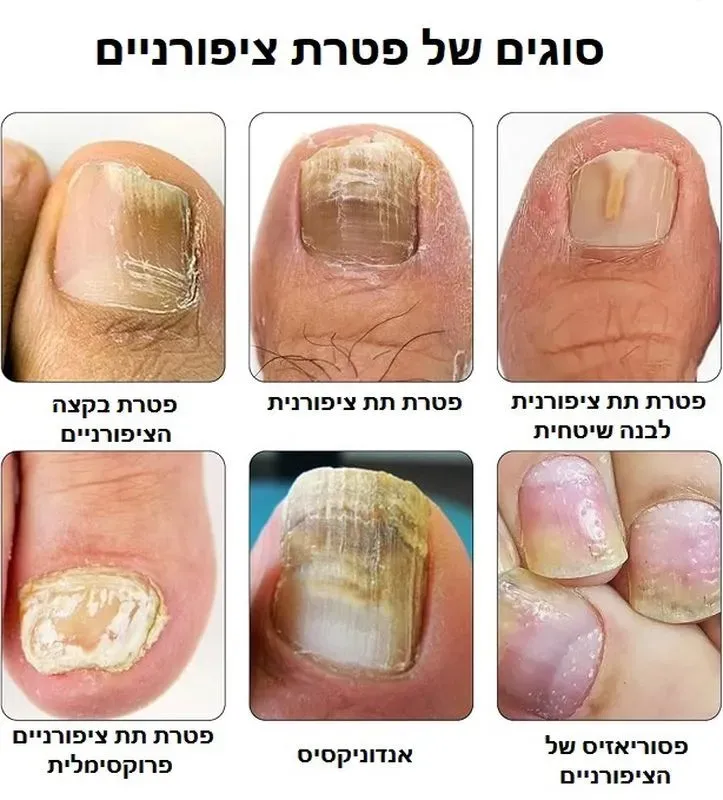 סוגים של פטרת ציפורניים